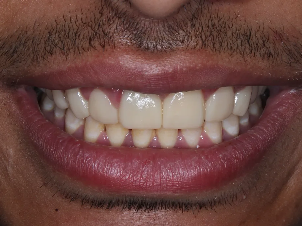After treatment, case 1