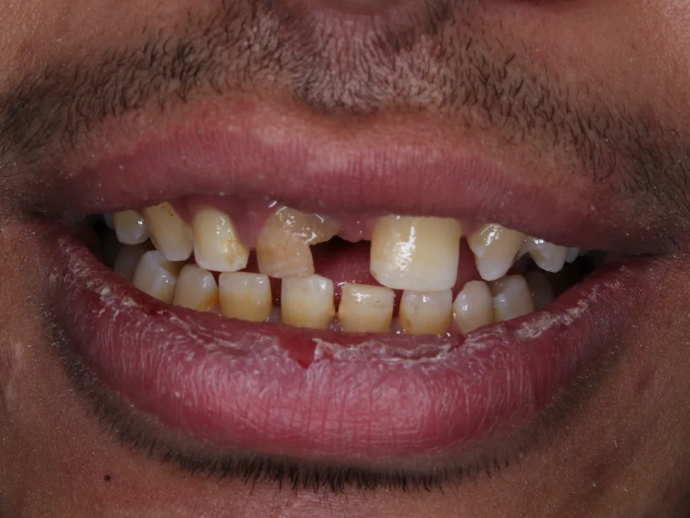 Before treatment, case 1