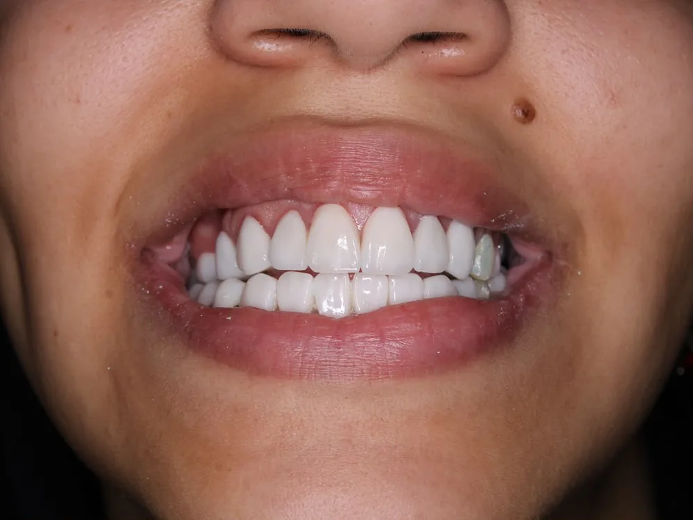 After treatment, case 2