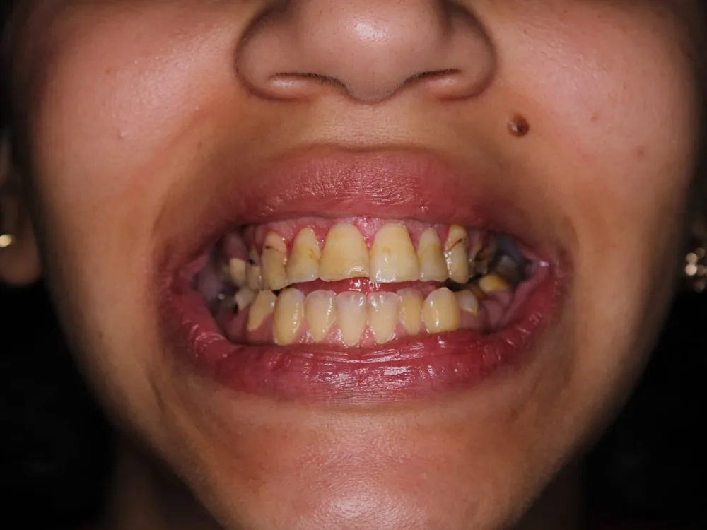 Before treatment, case 2